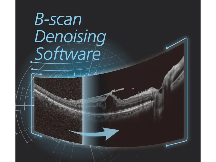 B-scan Denoising de NIDEK